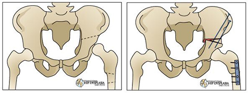 pelvic and femoral osteotomy