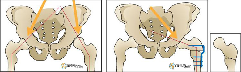 femoral osteotomy