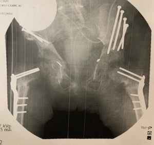 hip surgery