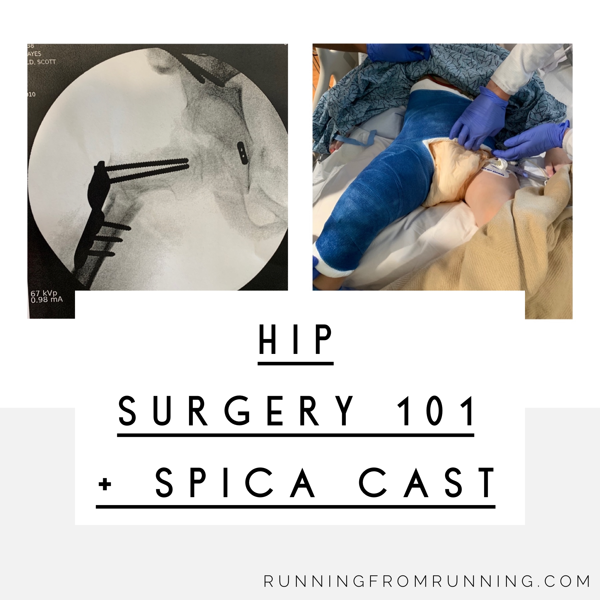 hip surgery 101 and spica cast